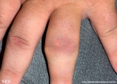 gout