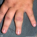 gout
