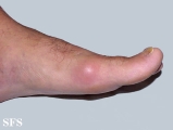 gout