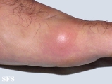 gout