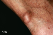 gout