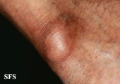 gout