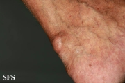 gout