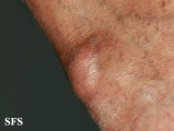 gout