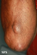 gout