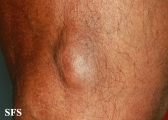 gout