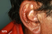 gout
