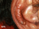 gout
