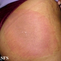 erythema chronicum migrans