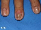 fibrolipoma