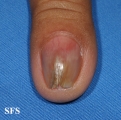 fibrolipoma
