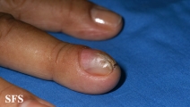 fibrolipoma