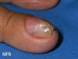 fibrolipoma