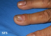 fibrolipoma