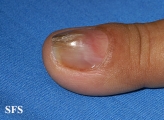 fibrolipoma
