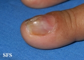 fibrolipoma