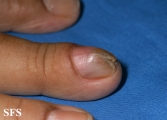 fibrolipoma