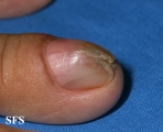 fibrolipoma