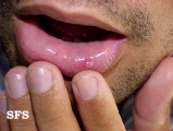 mucocele
