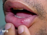 mucocele