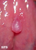 mucocele