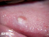 mucocele