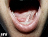 mucocele