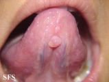 mucocele