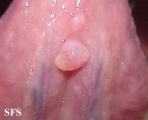 mucocele