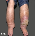 milroy's disease