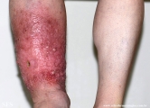 milroy's disease