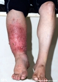 milroy's disease
