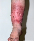 milroy's disease
