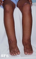 milroy's disease