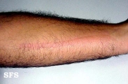 dermographism