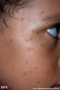 urticaria pigmentosa