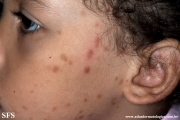 urticaria pigmentosa