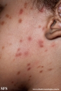 urticaria pigmentosa