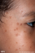 urticaria pigmentosa