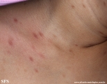 urticaria pigmentosa