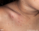 urticaria pigmentosa