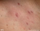 urticaria pigmentosa