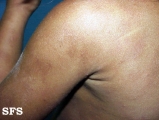 urticaria pigmentosa