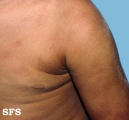 urticaria pigmentosa