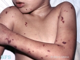 meningitis