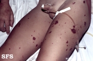meningitis