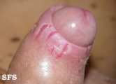 balanoposthitis