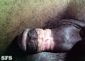 balanoposthitis