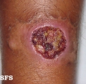 tropical ulcer