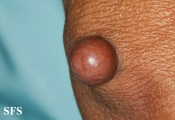 proliferating trichilemmal cyst